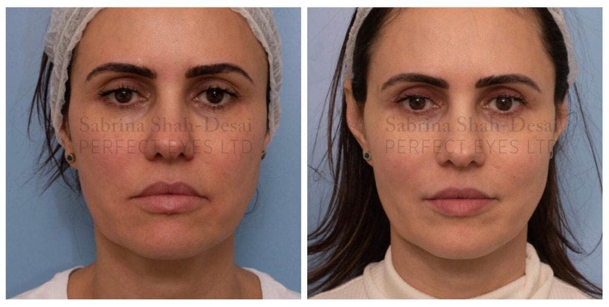 What is Silhouette Soft Thread Lift?
