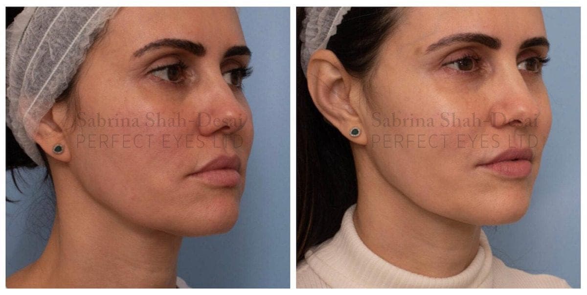 Silhouette Soft thread lift before and after result