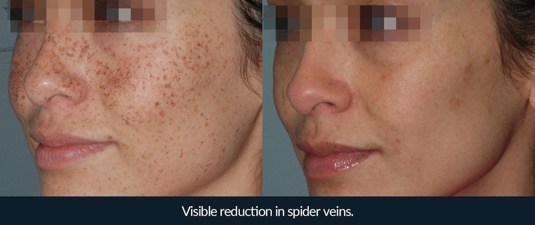 Morpheus8 before and after - case 7