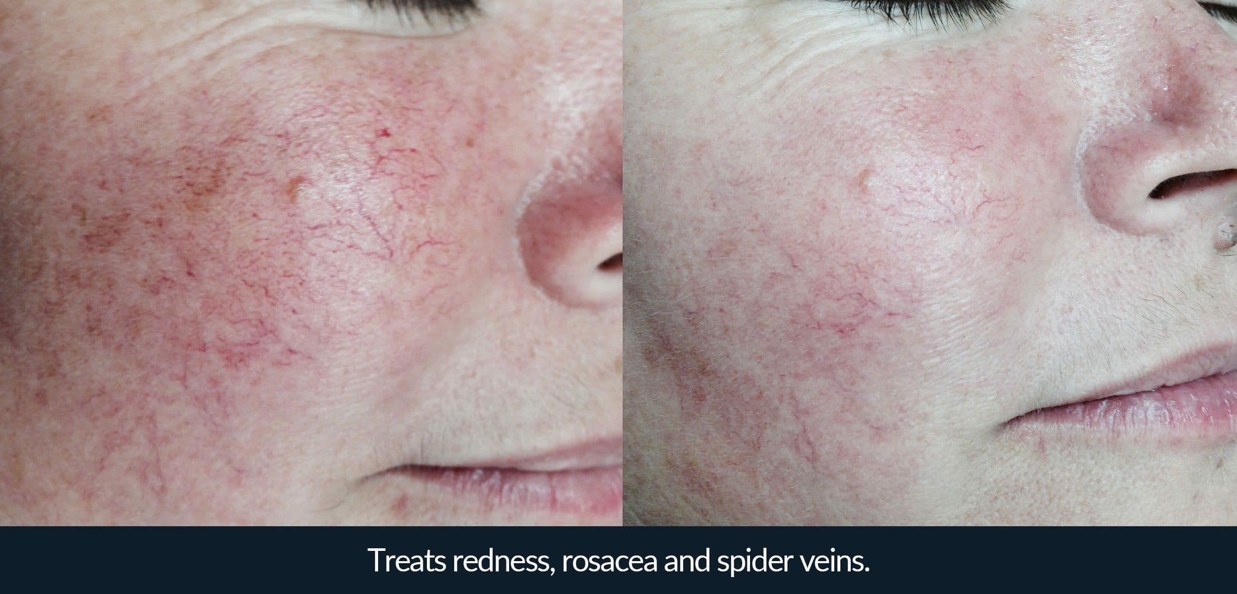 Morpheus8 before and after - case 8