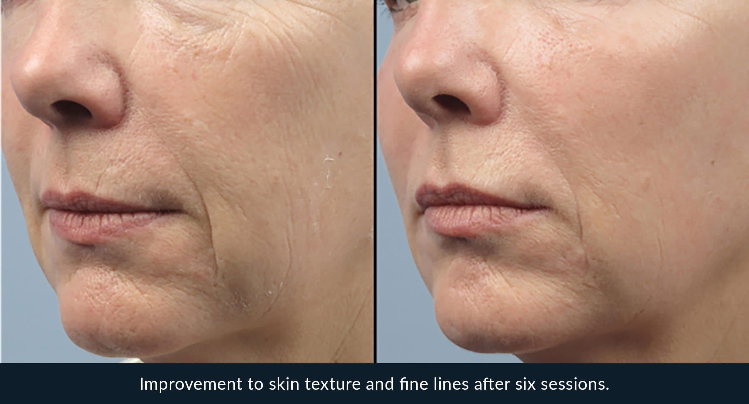Morpheus8 before and after - case 10