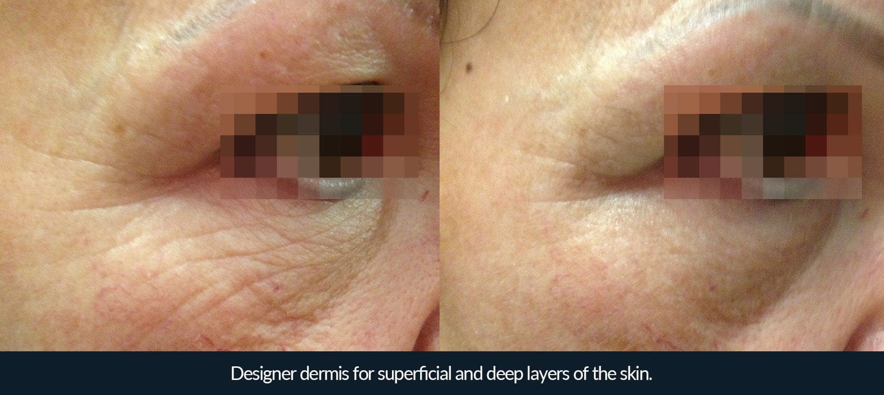 Morpheus8 before and after - case 4