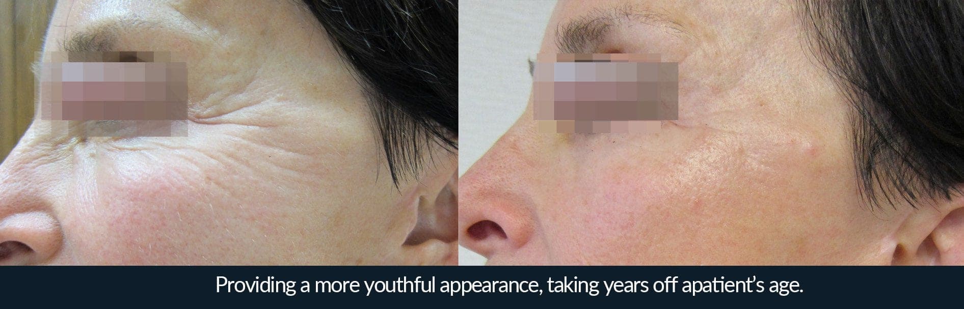 Morpheus8 before and after - case 5