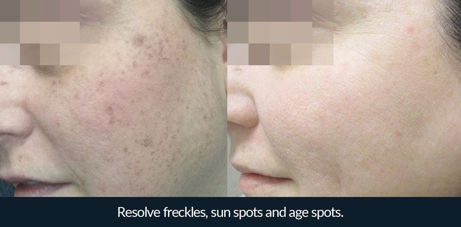Morpheus8 before and after - case 6