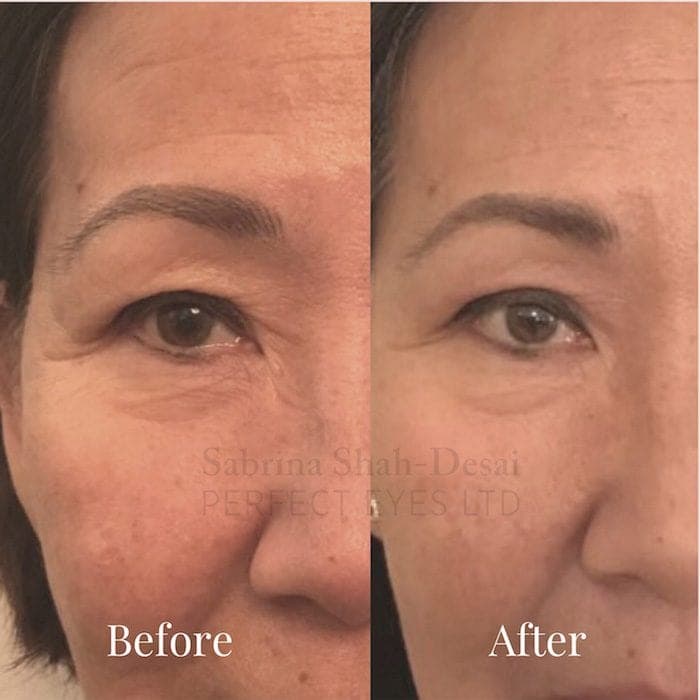 Double eyelid surgery before and after result