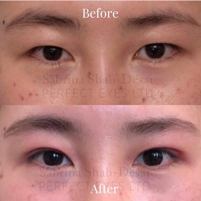 Double eyelid surgery before and after result