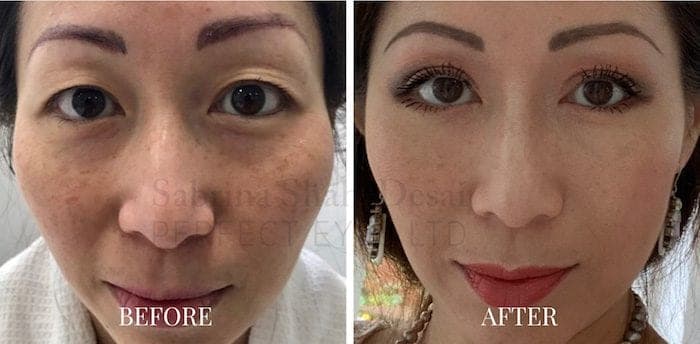 Double eyelid surgery before and after result