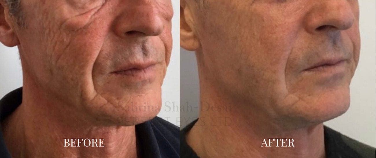 Morpheus8 before and after - case 2