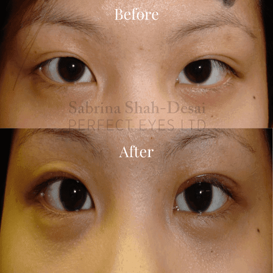 Double eyelid surgery before and after result