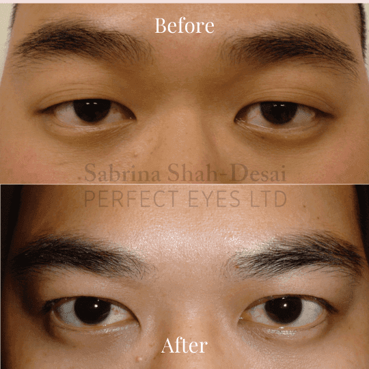 Double eyelid surgery before and after result - male patient