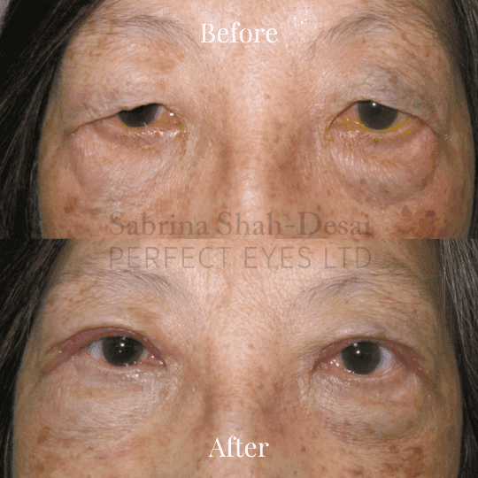 Double eyelid surgery before and after result - elderly patient