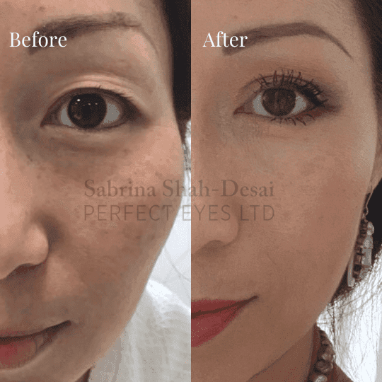Double eyelid surgery before and after result