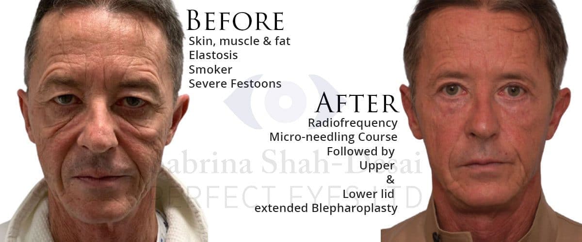 Severe festoons before, and after radiofrequency micro-needling with upper and lower lid extended blepharoplasty
