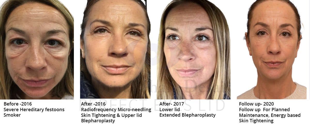 Severe hereditary festoons over a multi-year course of radiofrequency micro-needling and extended blepharoplasty, with a planned maintenance follow-up