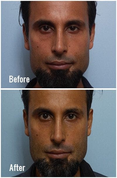 Polynucleotides under-eye rejuvenation before and after - case 2