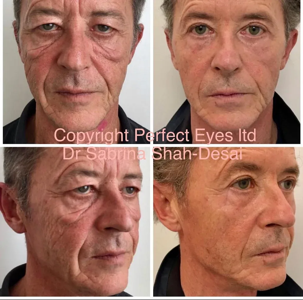 Morpheus8 before and after - case 12