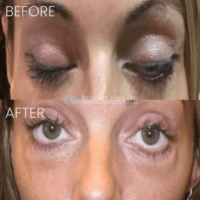Before and after Revision Blepharoplasty, a patient of Dr Sabrina Shah-Desai