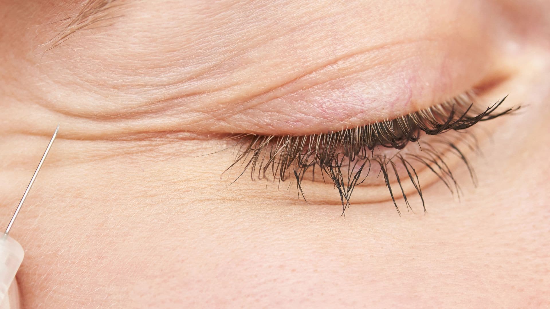 How To Reduce And Prevent Eye Crow's Feet?