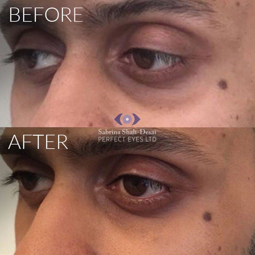 Tear trough fillers before and after - case 3