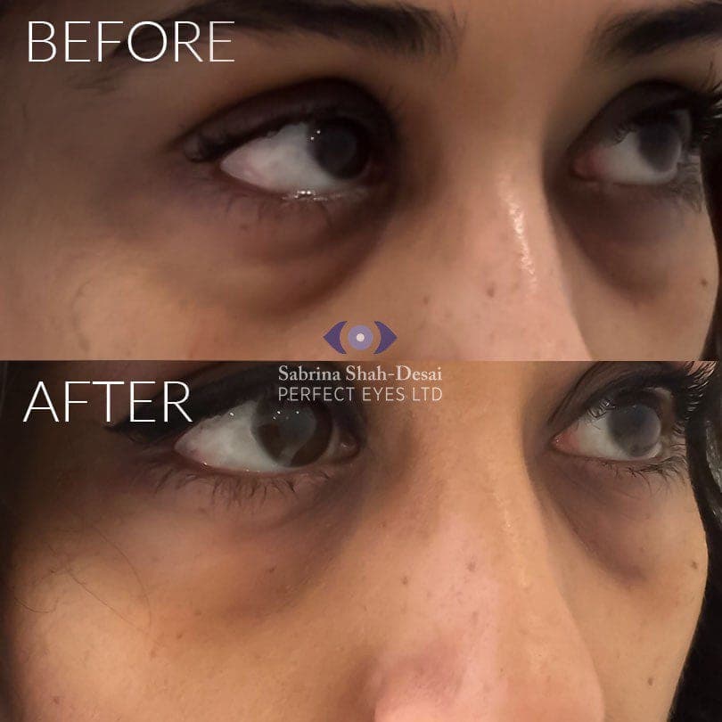 Tear trough fillers before and after - case 2