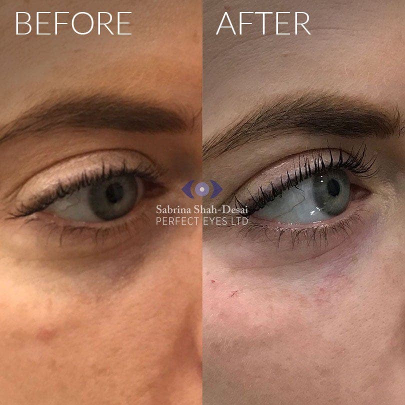 Tear trough fillers before and after - case 5