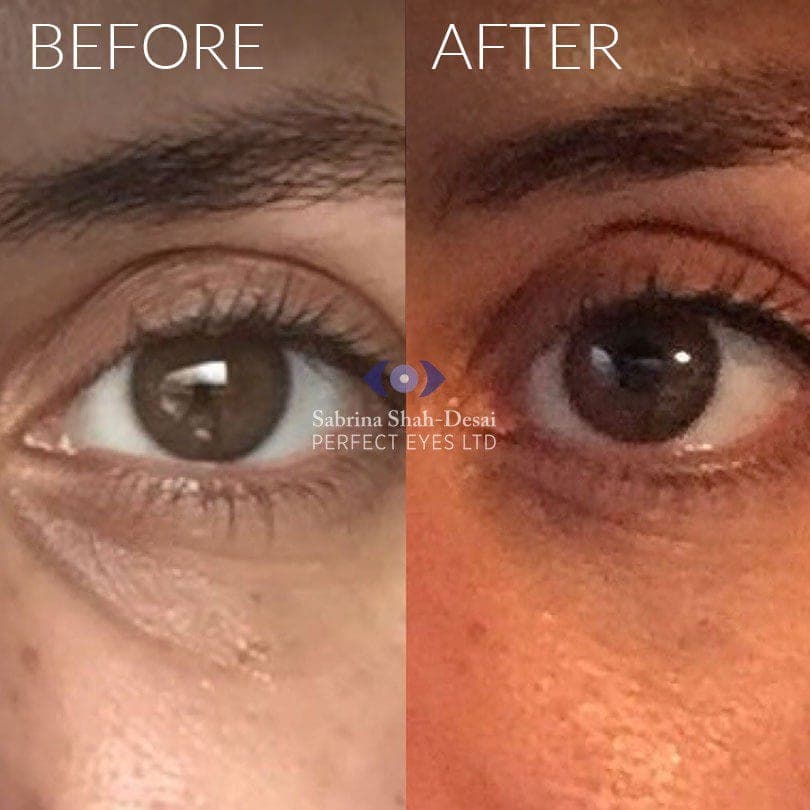 Tear trough fillers before and after - case 4