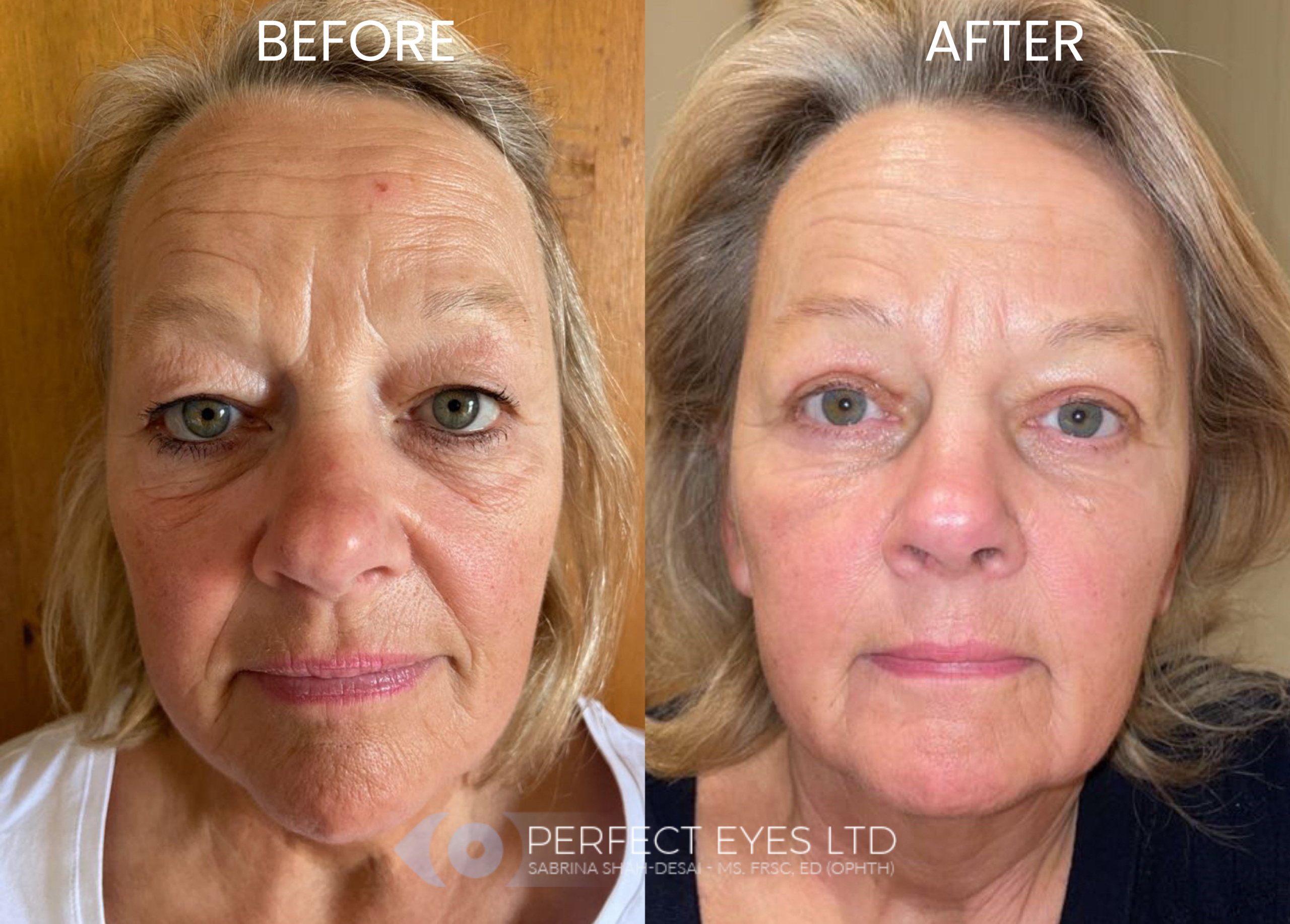 UltraClear Laser before and after - case 2