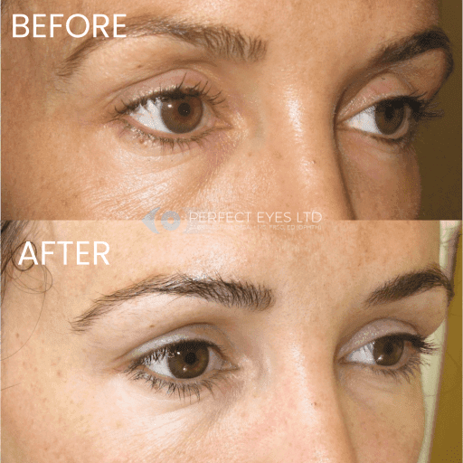 Superior sulcus and temple filler before and after - case 2