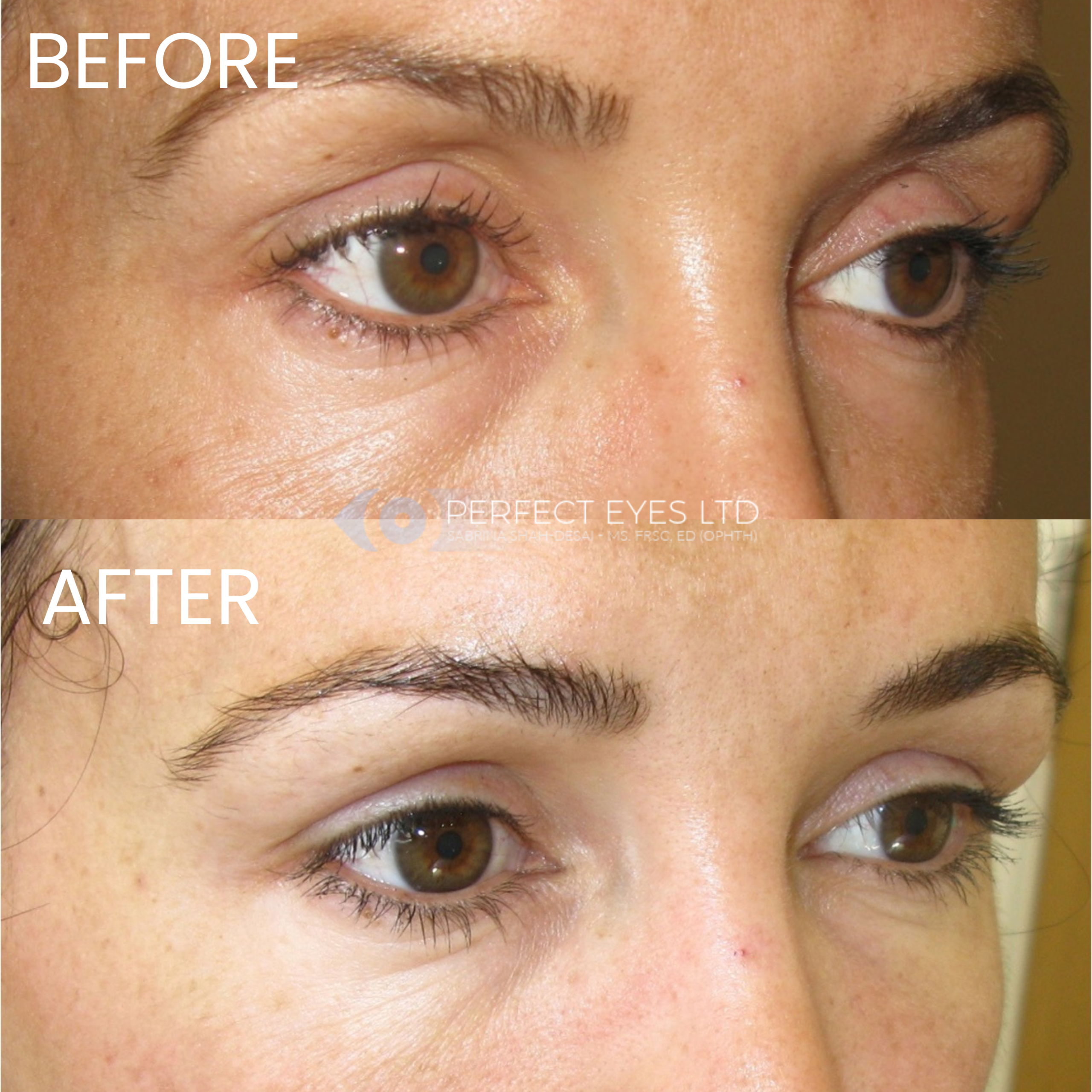 Superior Sulcus Filler before and after - case 1