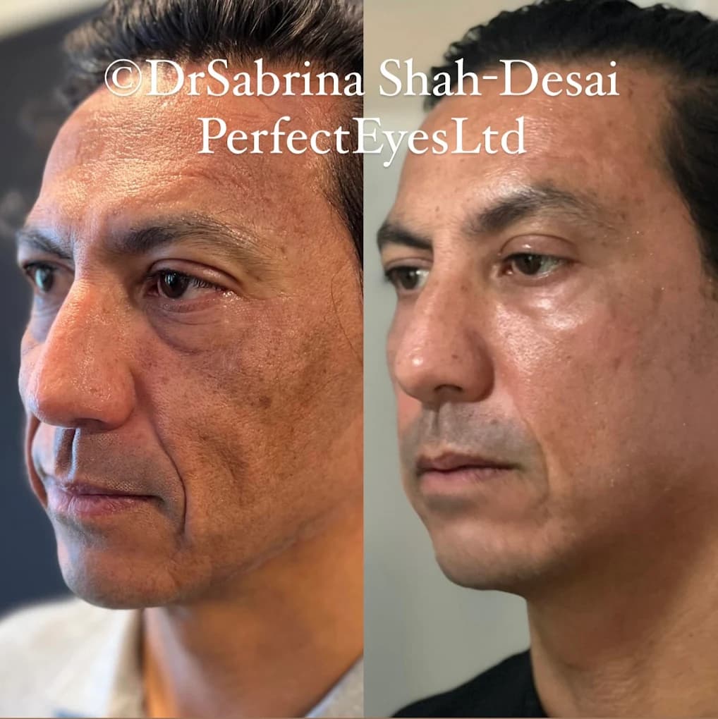 UltraClear Laser before and after - case 9