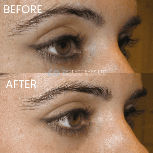 Temple Fillers before and after, a patient of Dr Sabrina Shah-Desai