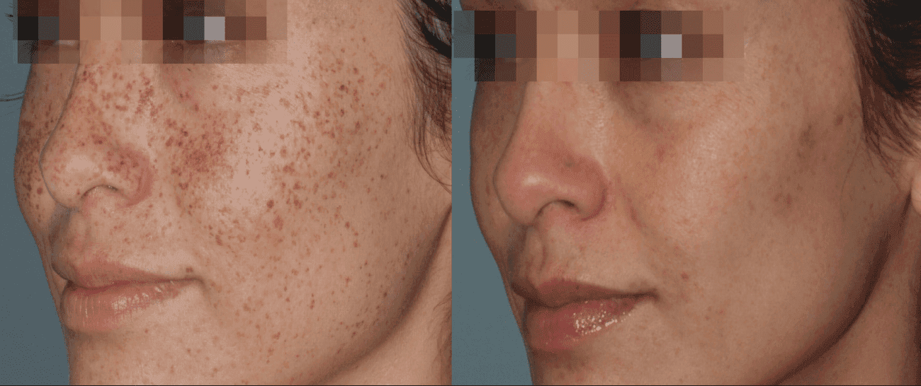Morpheus8 before and after - case 5