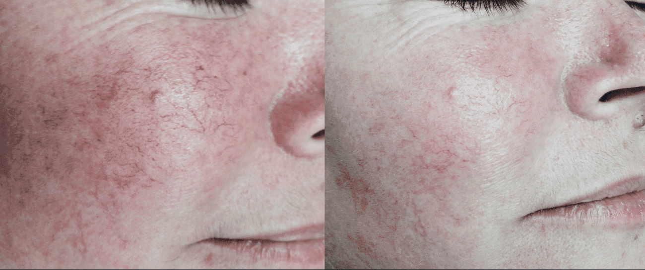 Morpheus8 before and after - case 4