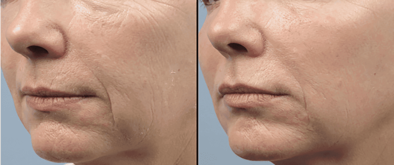 Morpheus8 before and after - case 11
