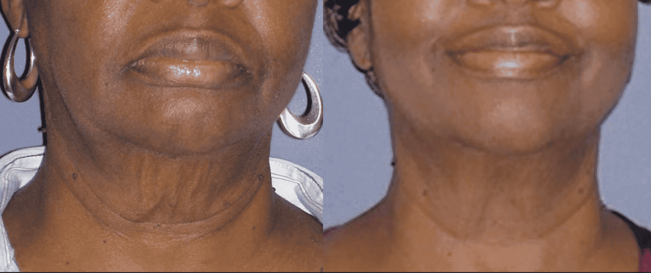 Morpheus8 before and after - case 9