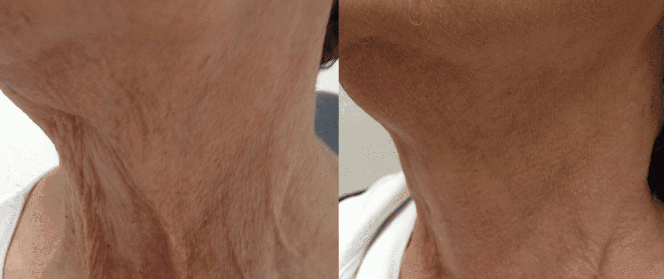 Morpheus8 before and after - case 8