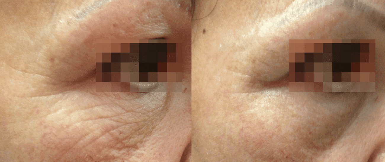 Morpheus8 before and after - case 7