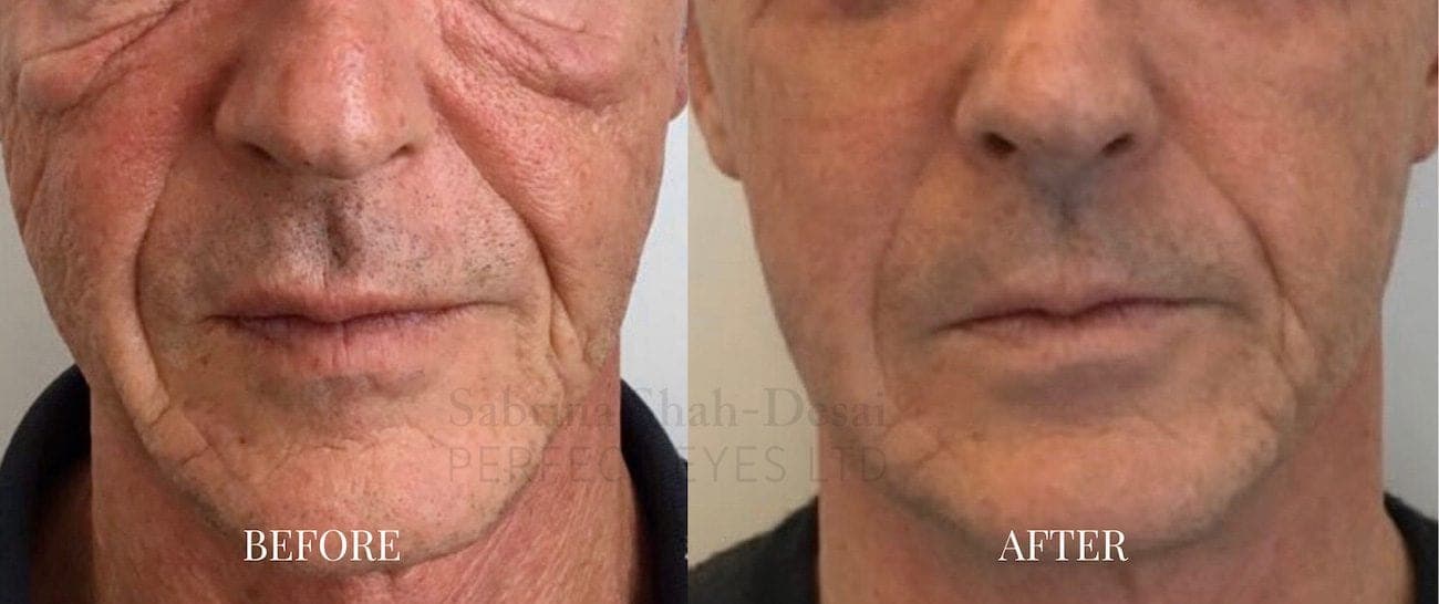 Before and after Morpheus8, a patient of Dr Sabrina Shah-Desai
