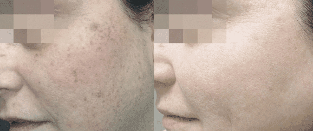 Morpheus8 before and after - case 6