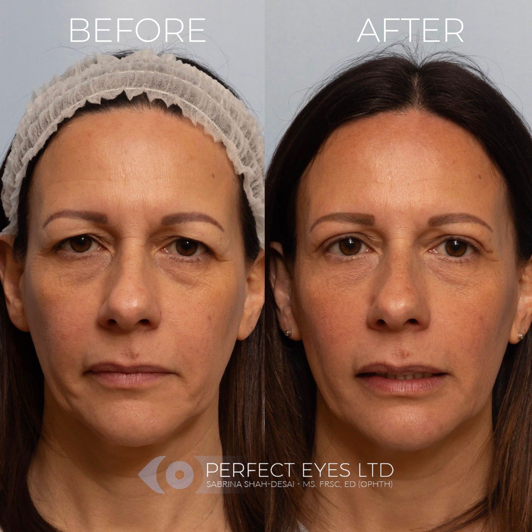 Blepharoplasty before and after - case 2