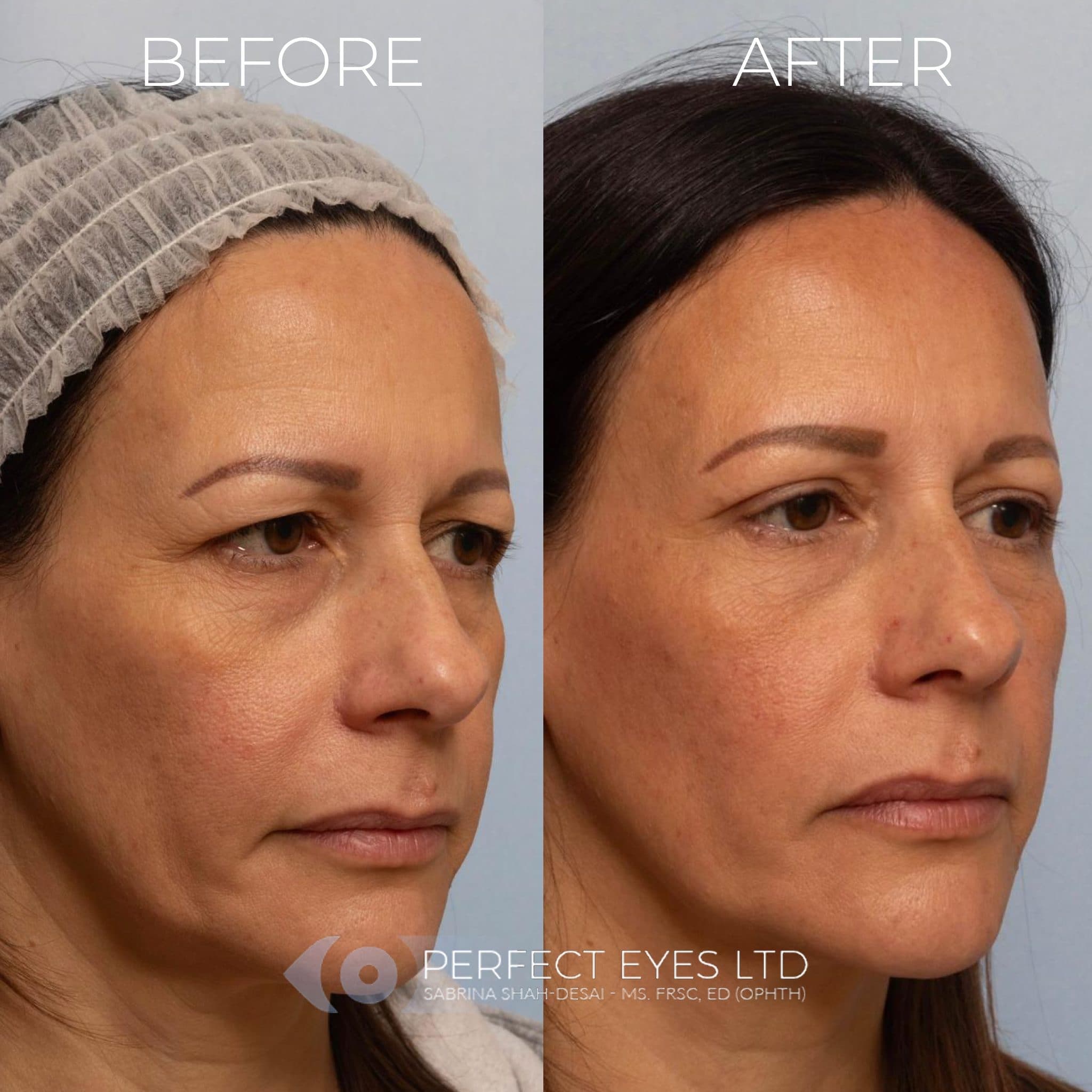 Blepharoplasty before and after - case 3