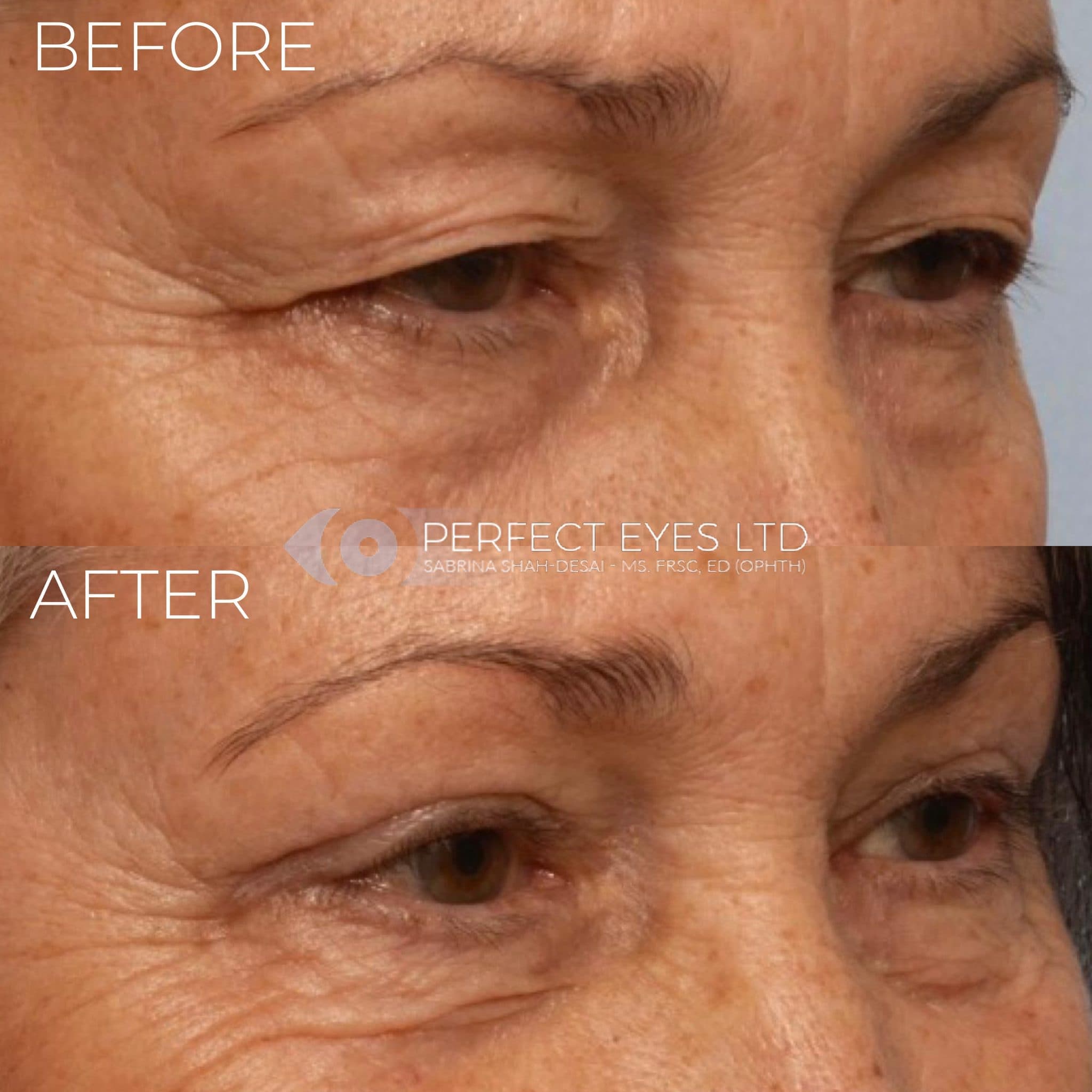Blepharoplasty before and after - case 4