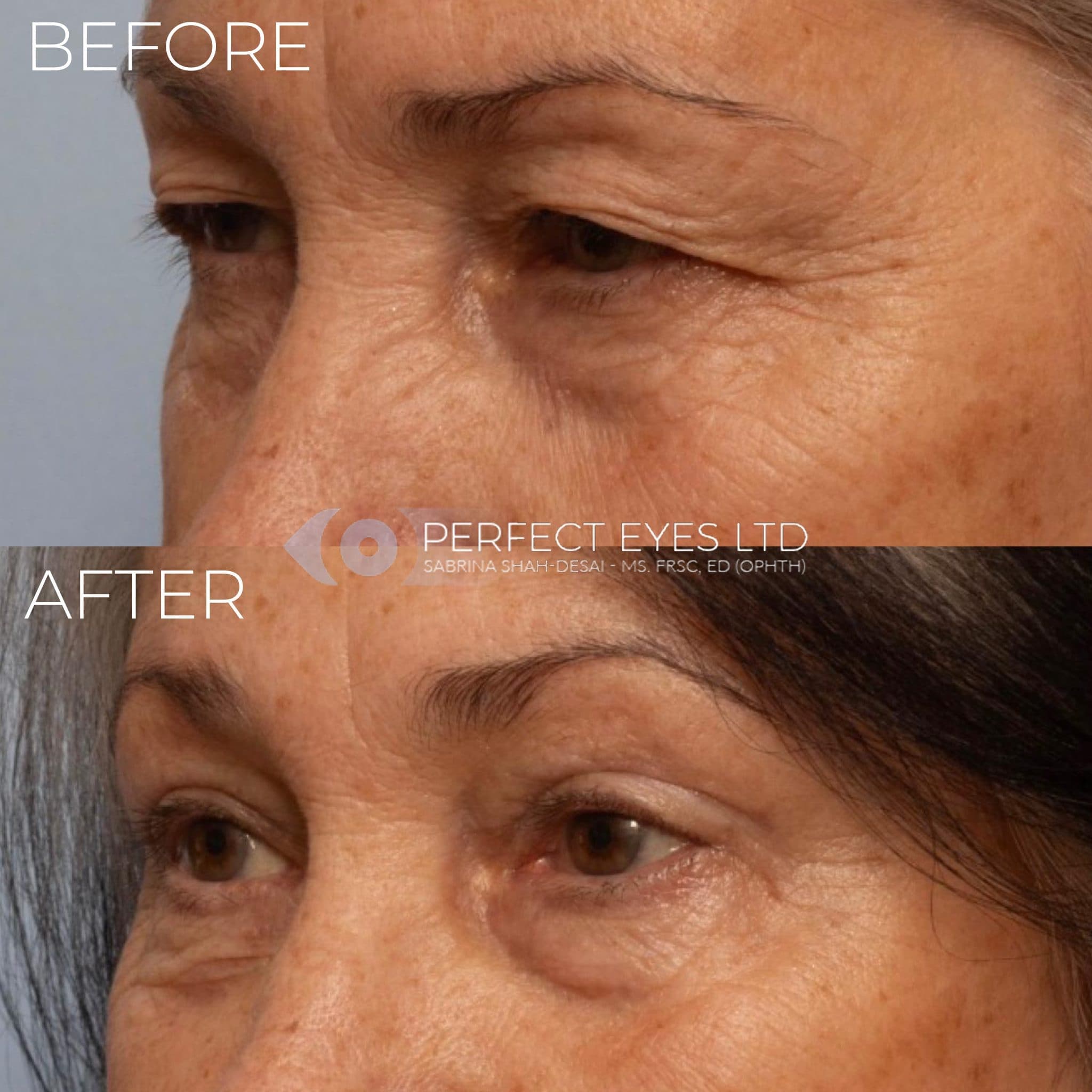 Blepharoplasty before and after - case 5