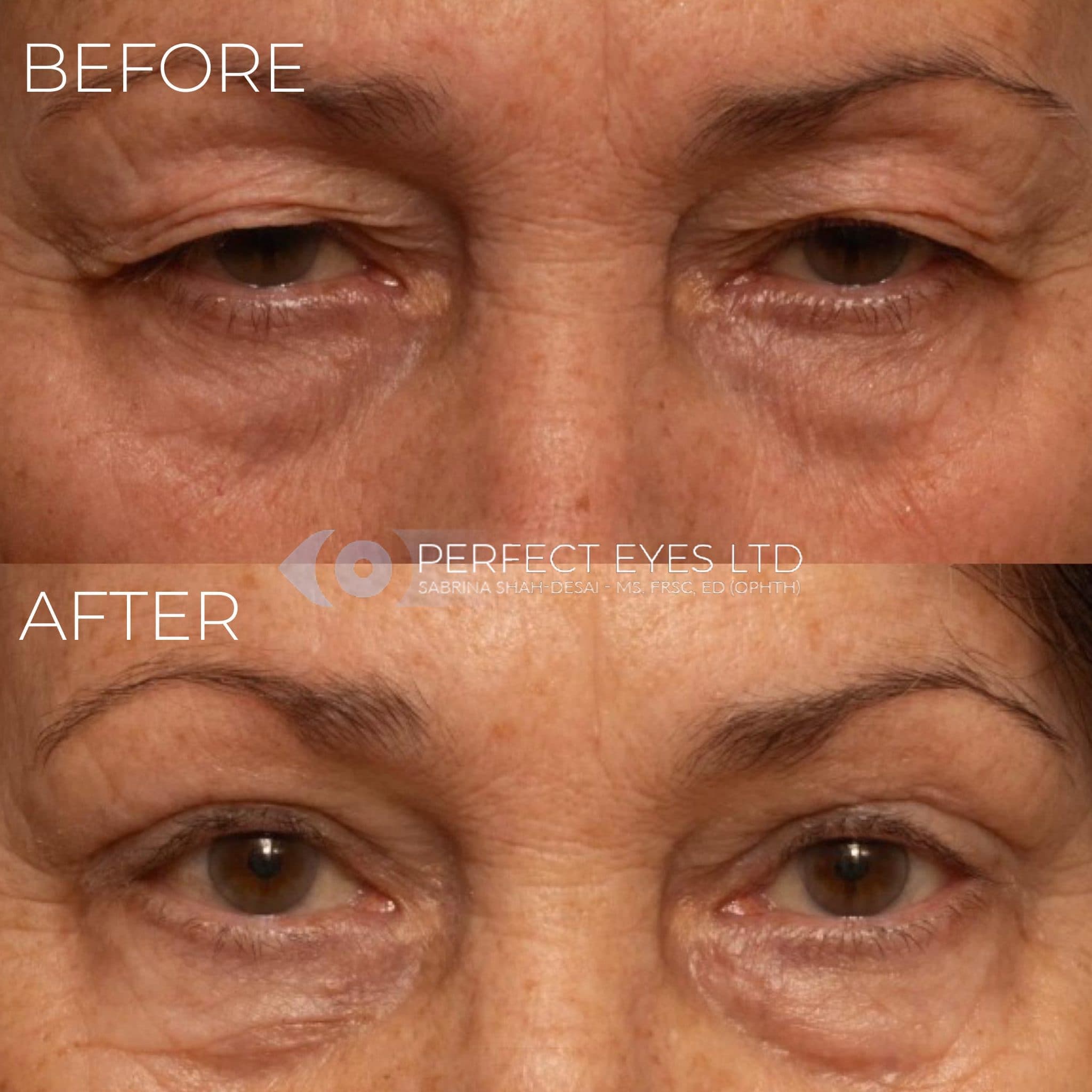 Blepharoplasty before and after - case 6