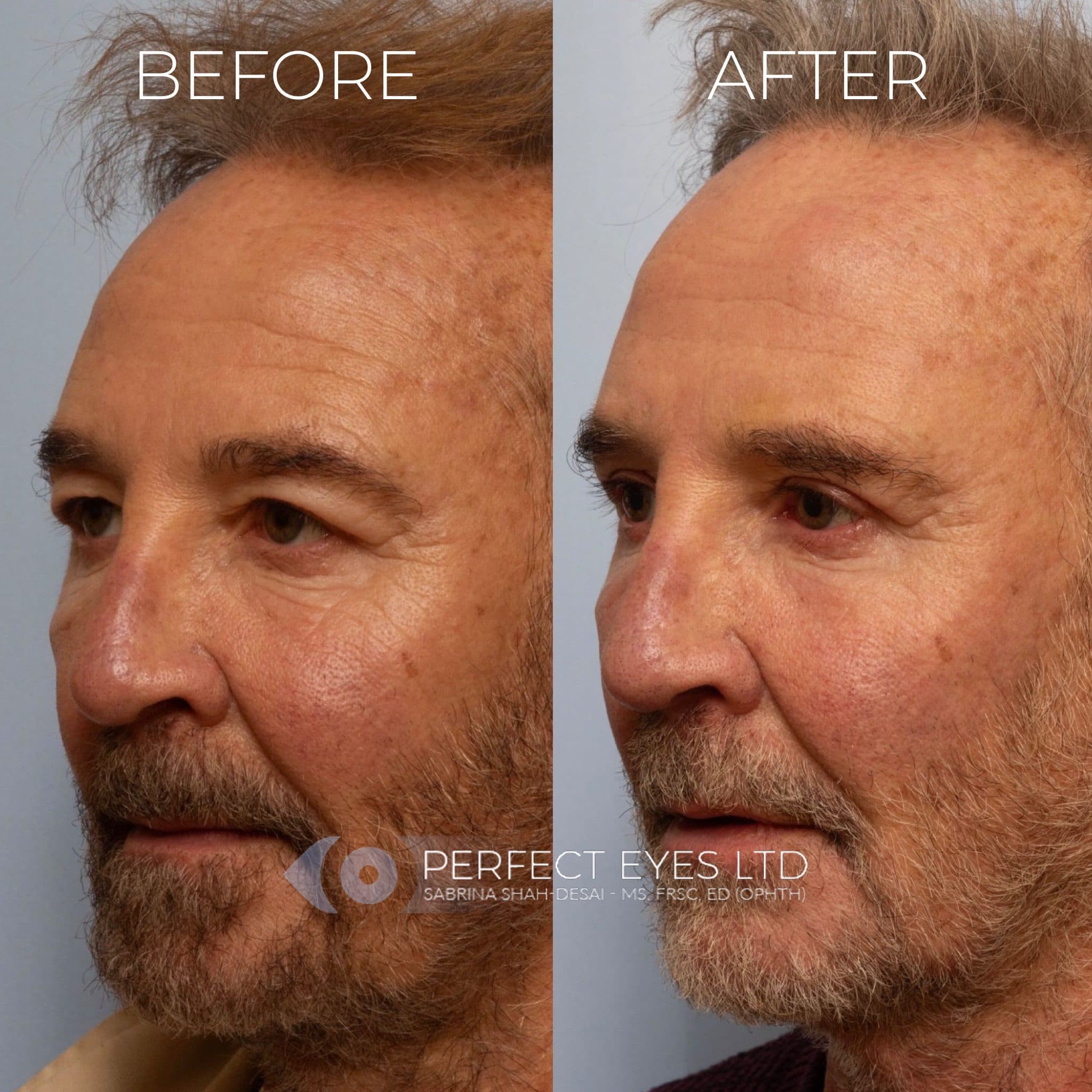 Blepharoplasty before and after - case 7