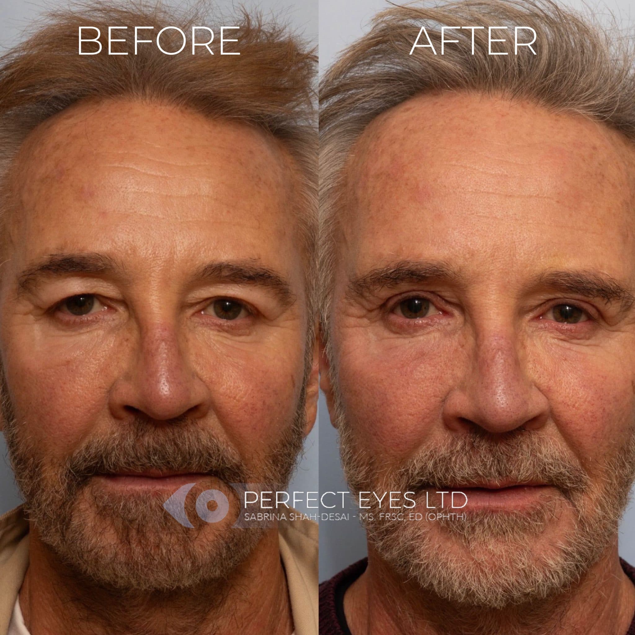 Blepharoplasty before and after - case 8