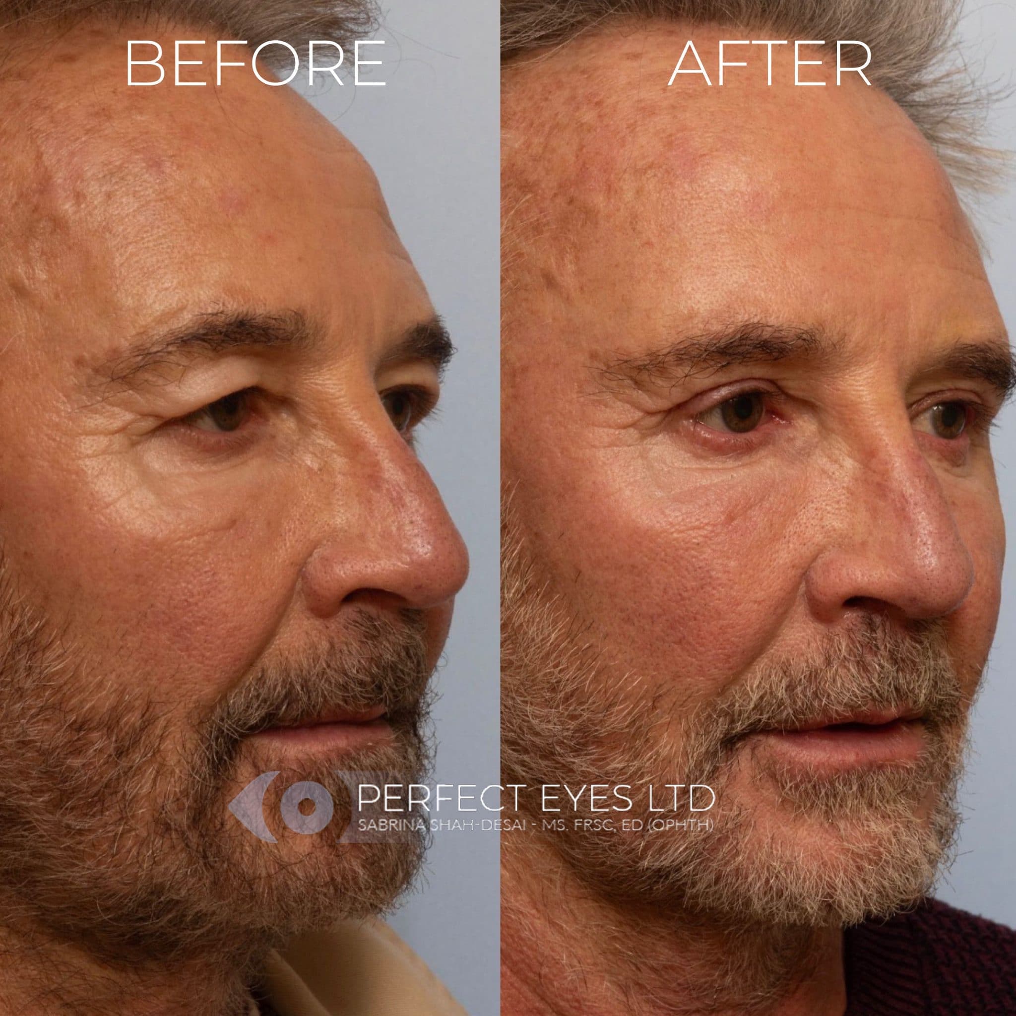 Blepharoplasty before and after - case 9