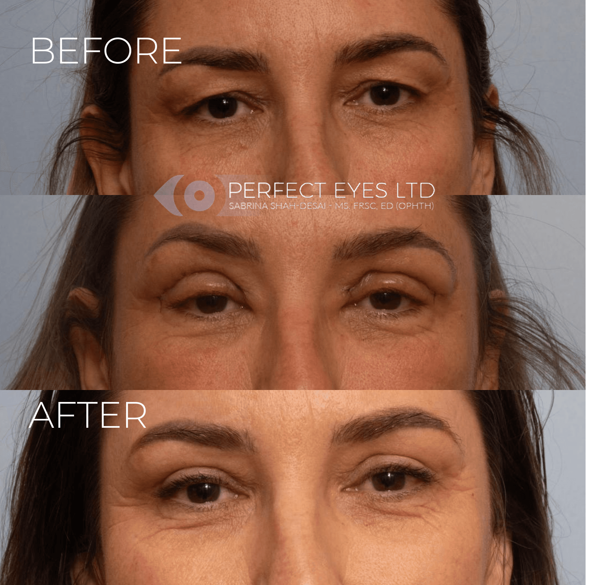 Blepharoplasty before and after - case 10
