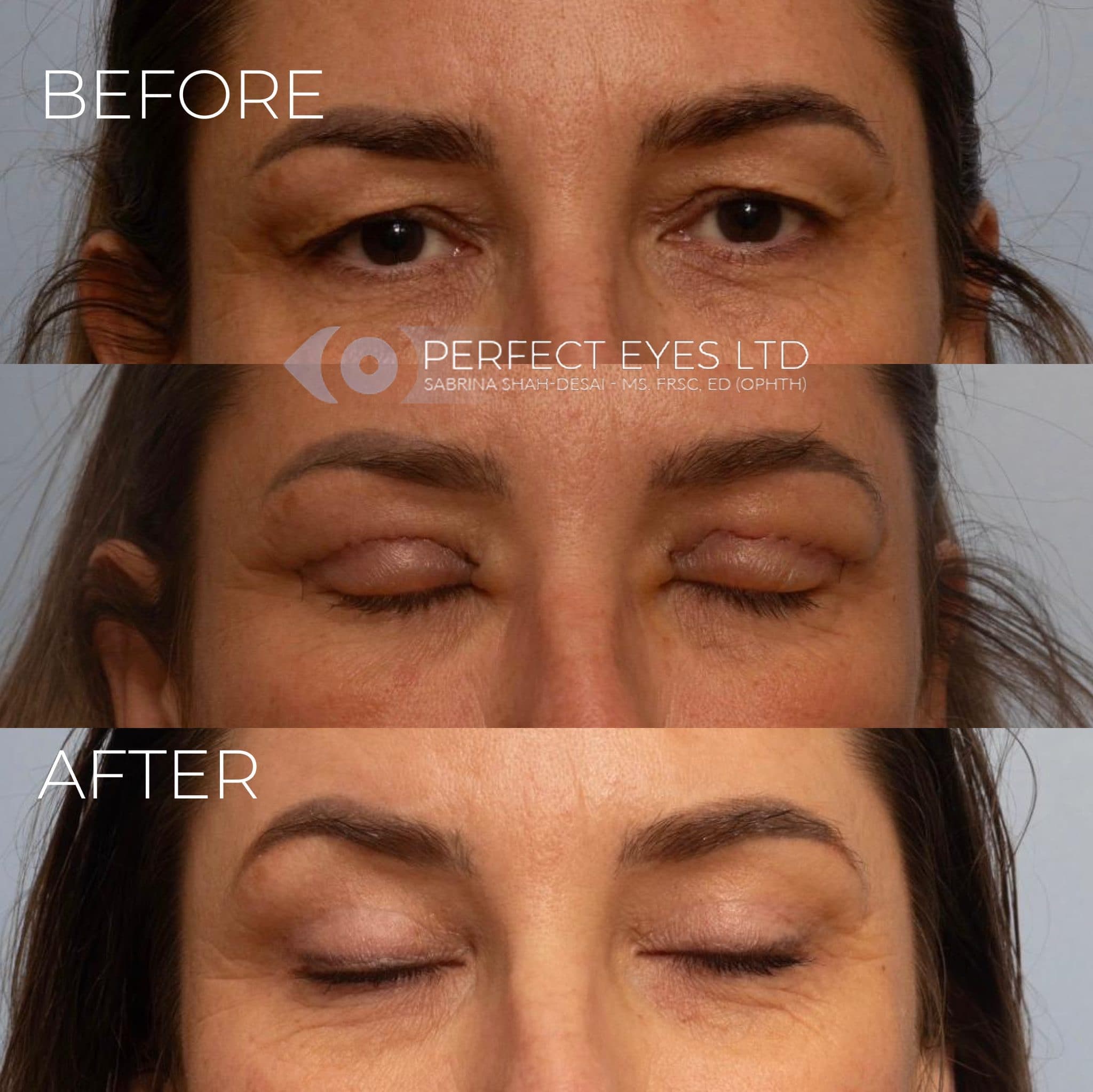 Blepharoplasty before and after - case 12