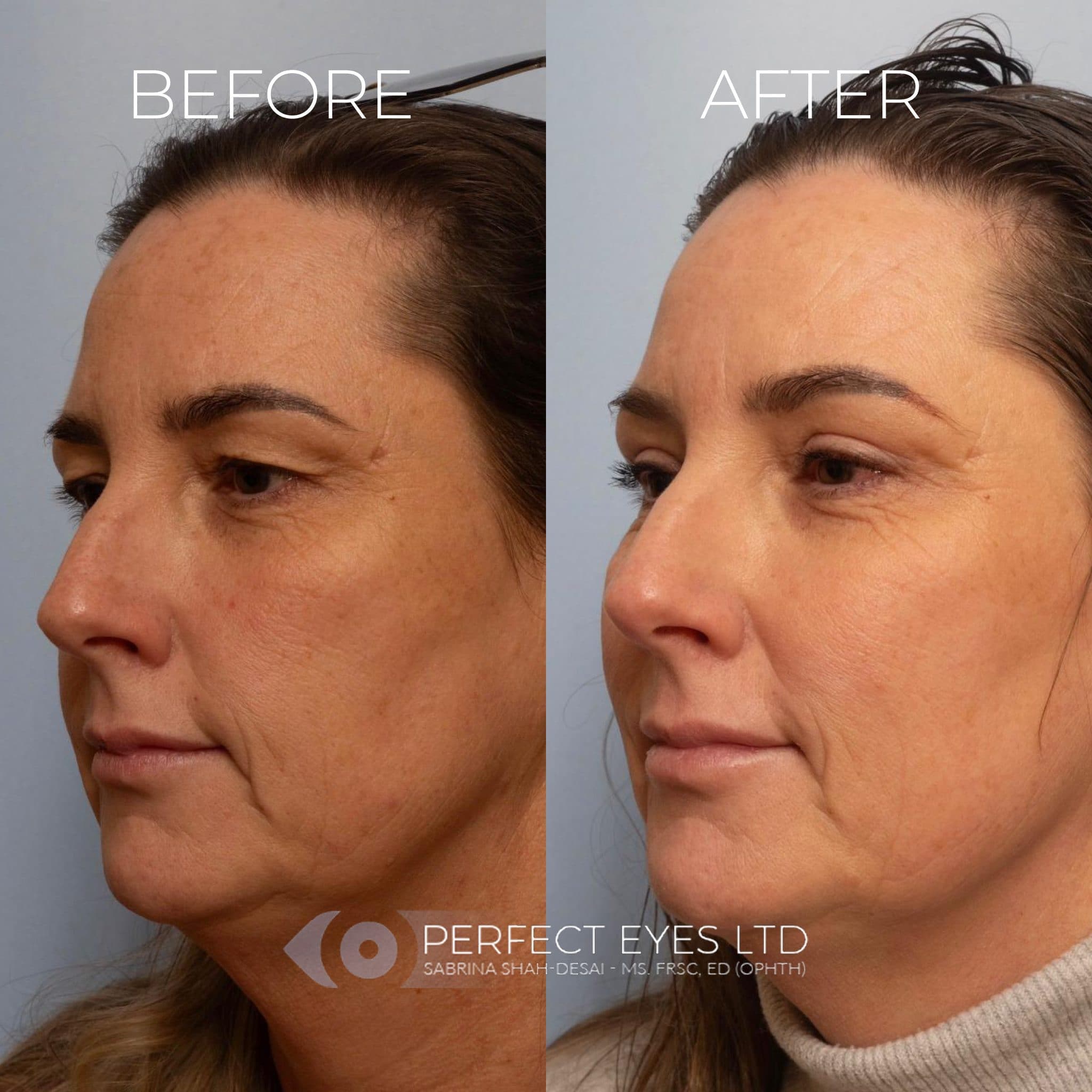 Blepharoplasty before and after - case 11